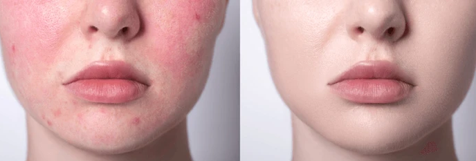Sensitive Skin and Acne: Understanding & Treating the Double Challenge
