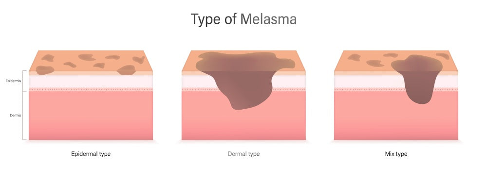What is Melasma?  Is Pico Laser Effective for Melasma?